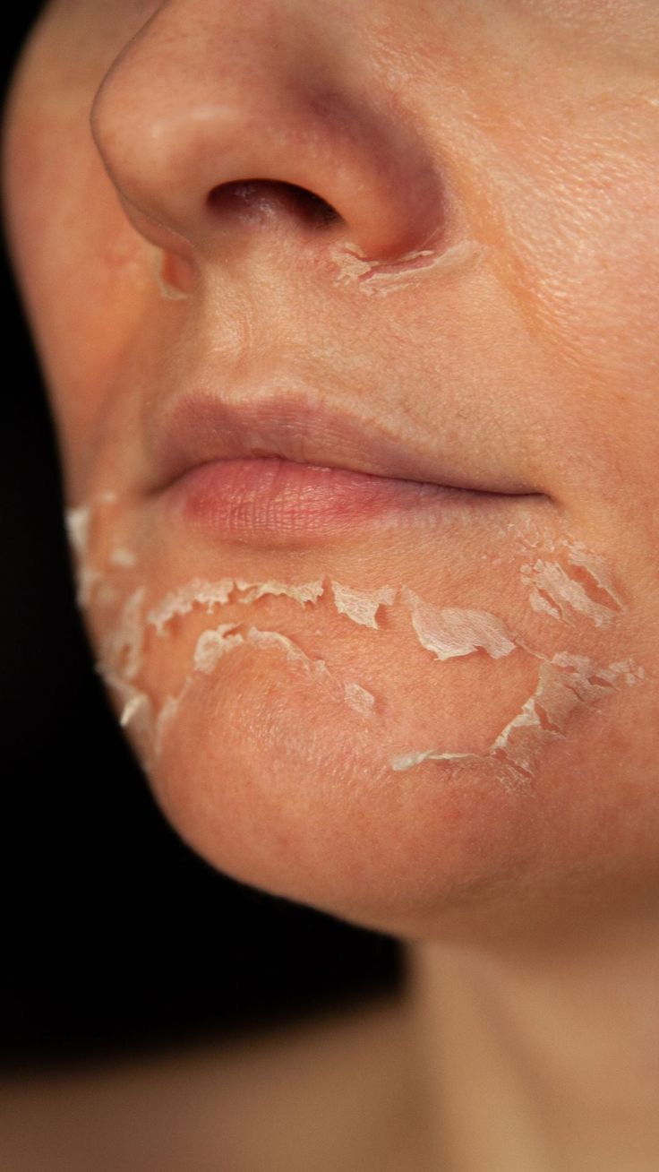 Peeling Quimico